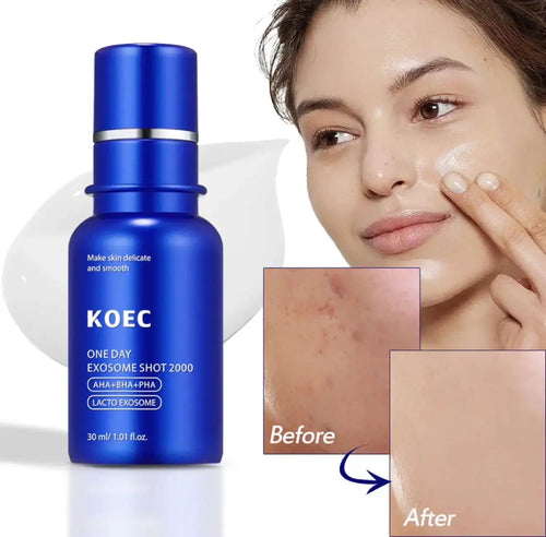 "Blue bottle of KOEC One Day Exosome Shot 2000 serum with white label, next to before and after skin close-ups."