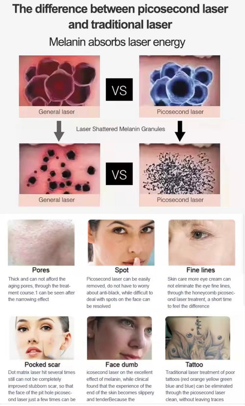 Supplier picosecond laser technology infographic; treatment claims not independently verified