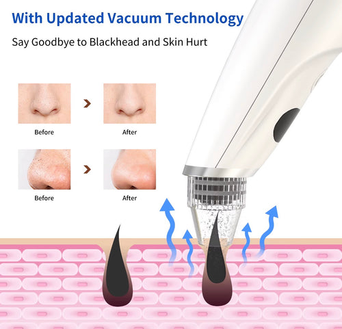 Vacuum pore cleansing device for targeted nose and facial pore care